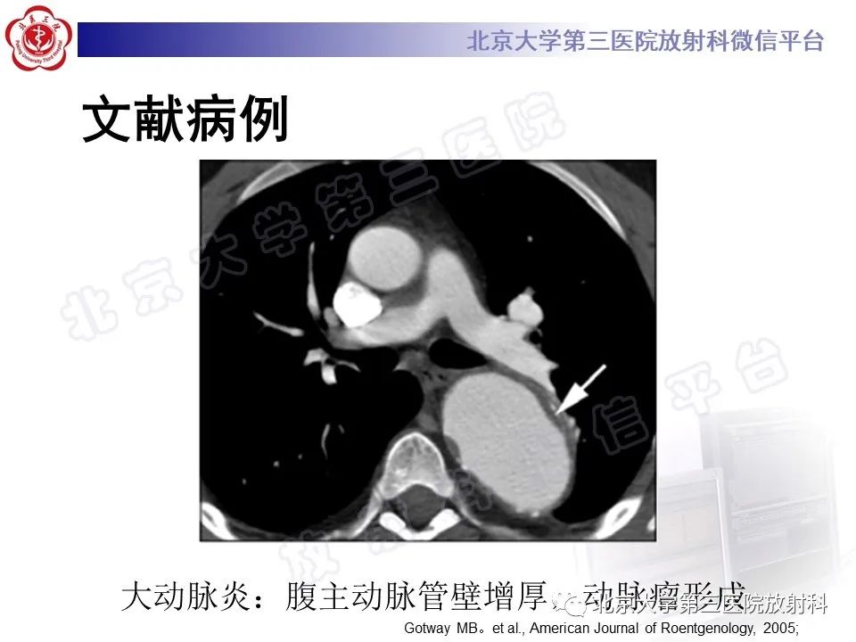 影像PPT - 【PPT】大动脉炎-23