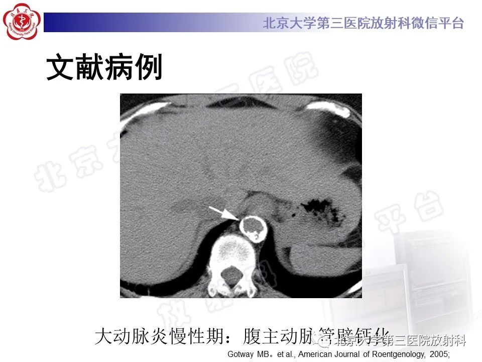 影像PPT - 【PPT】大动脉炎-24
