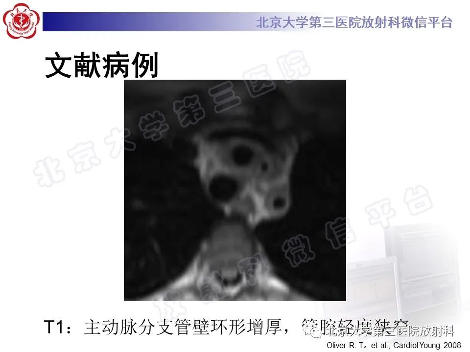 影像PPT - 【PPT】大动脉炎-25