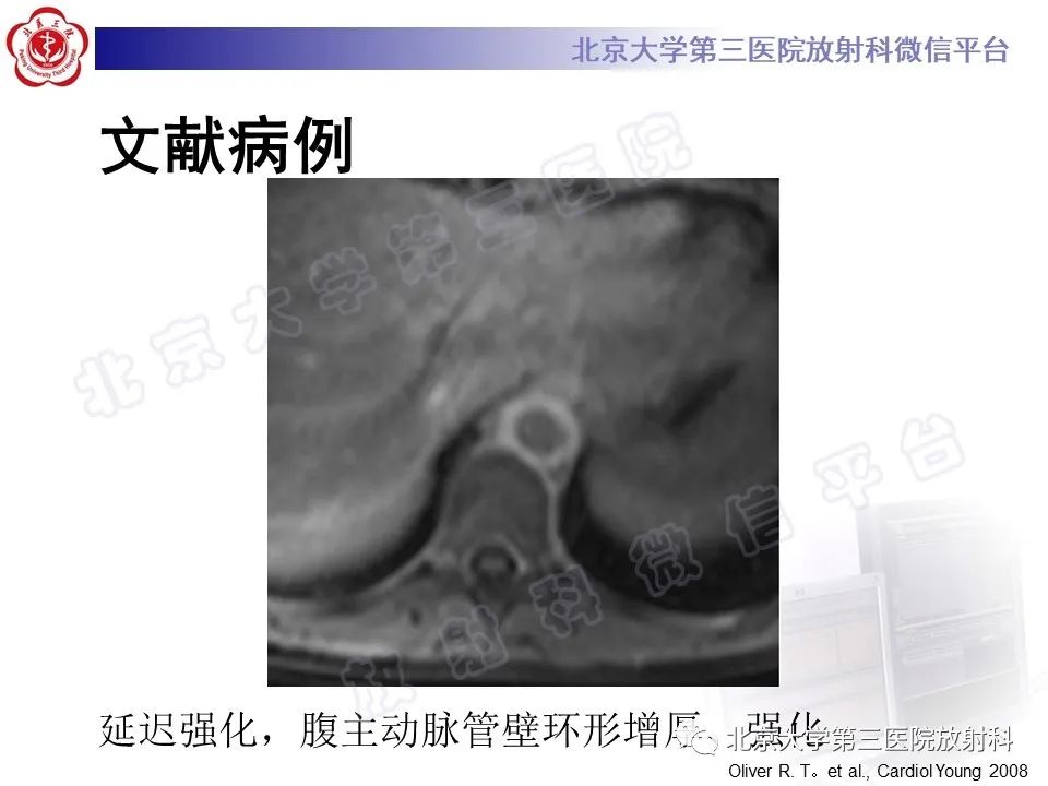 影像PPT - 【PPT】大动脉炎-26