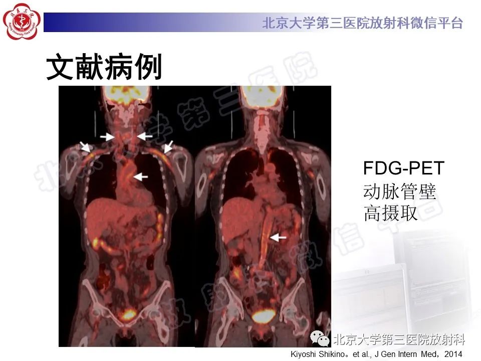 影像PPT - 【PPT】大动脉炎-27