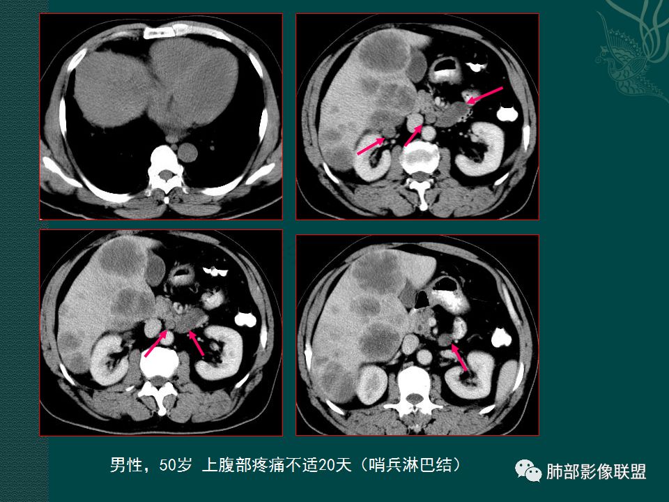 影像PPT - 【PPT】胃肠道肿瘤特征性影像浅析-11