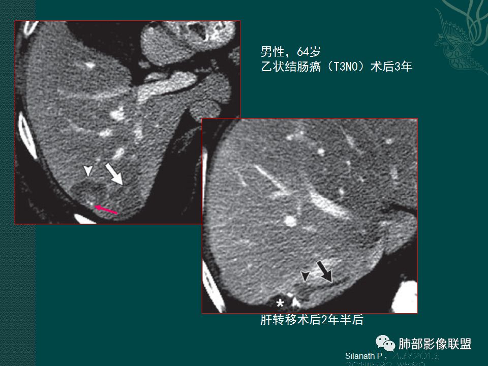 影像PPT - 【PPT】胃肠道肿瘤特征性影像浅析-20
