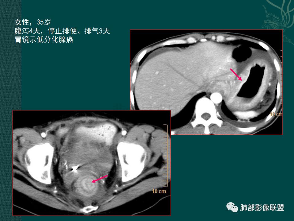 影像PPT - 【PPT】胃肠道肿瘤特征性影像浅析-25
