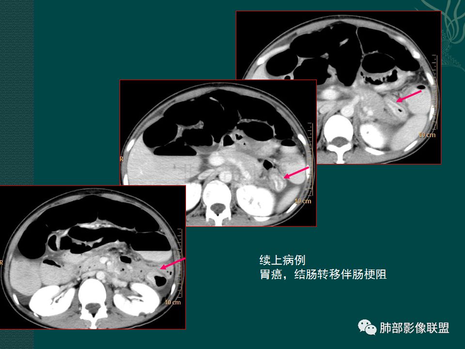 影像PPT - 【PPT】胃肠道肿瘤特征性影像浅析-29