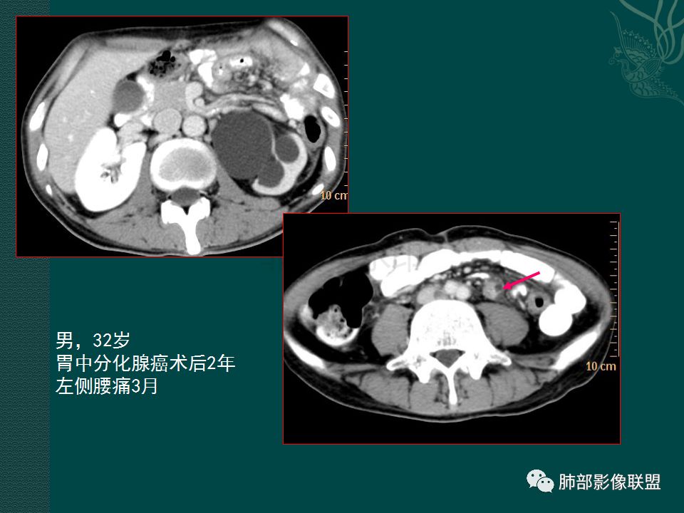 影像PPT - 【PPT】胃肠道肿瘤特征性影像浅析-33