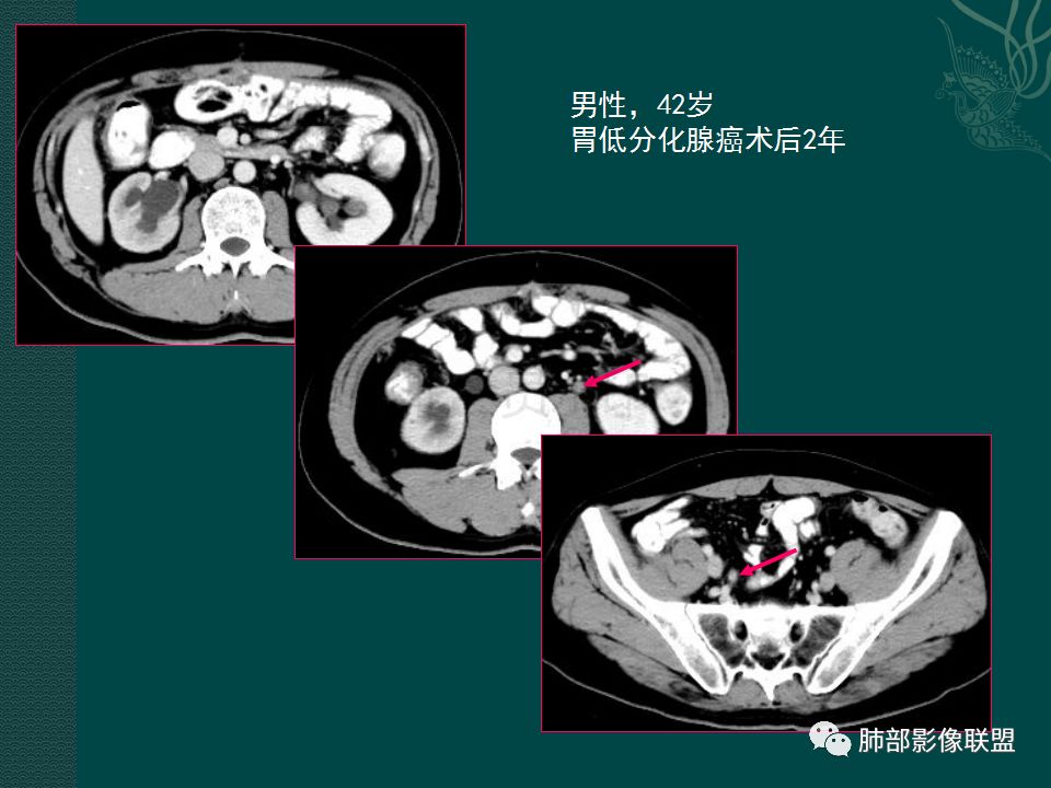 影像PPT - 【PPT】胃肠道肿瘤特征性影像浅析-35