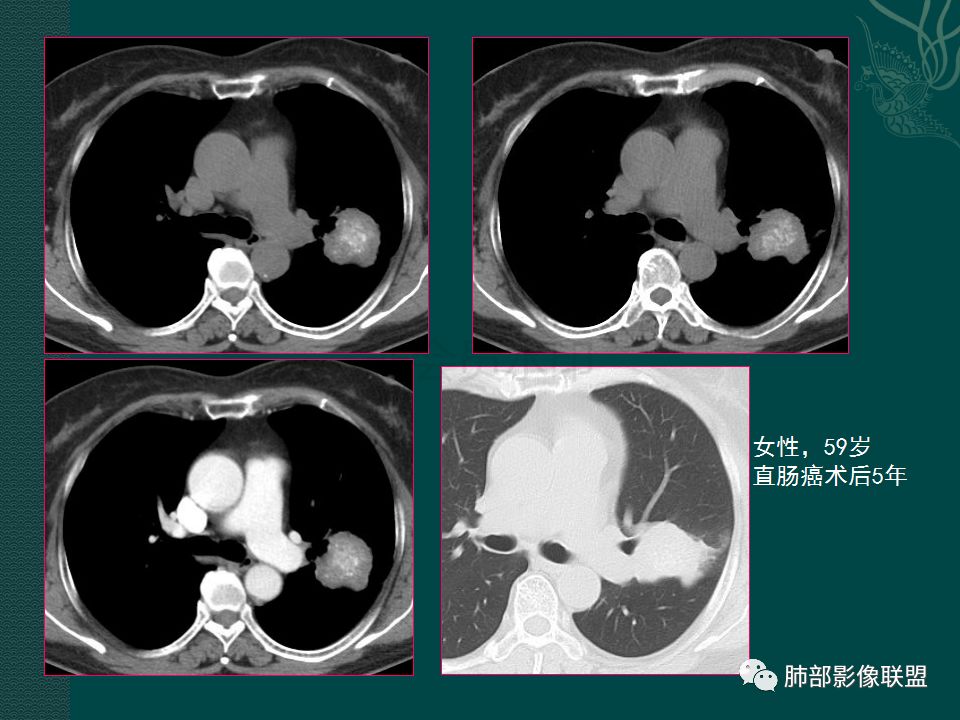 影像PPT - 【PPT】胃肠道肿瘤特征性影像浅析-36