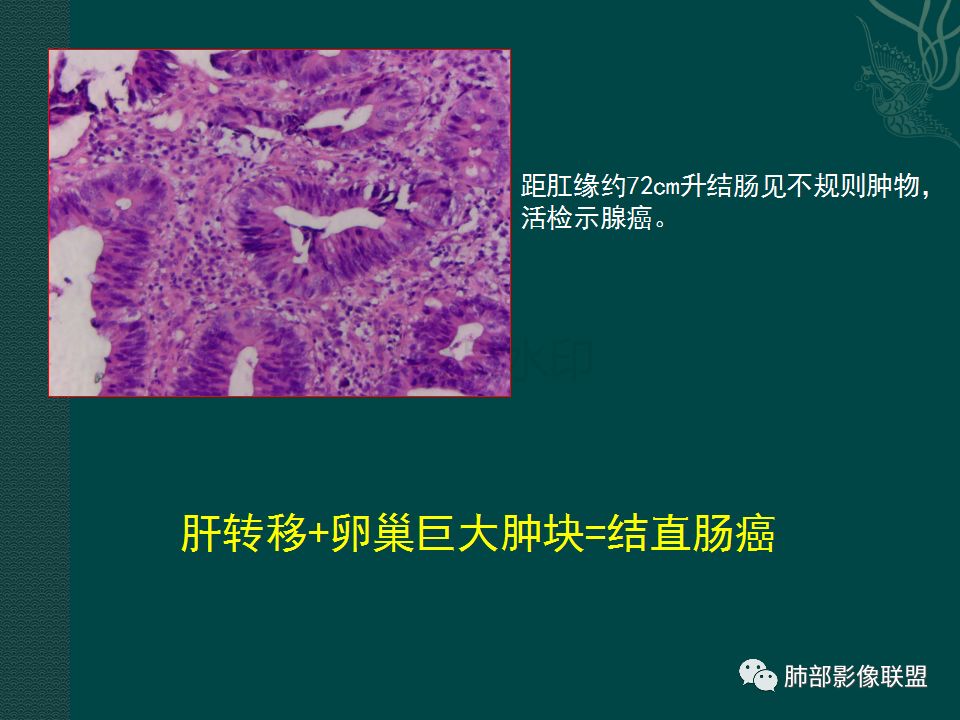 影像PPT - 【PPT】胃肠道肿瘤特征性影像浅析-50