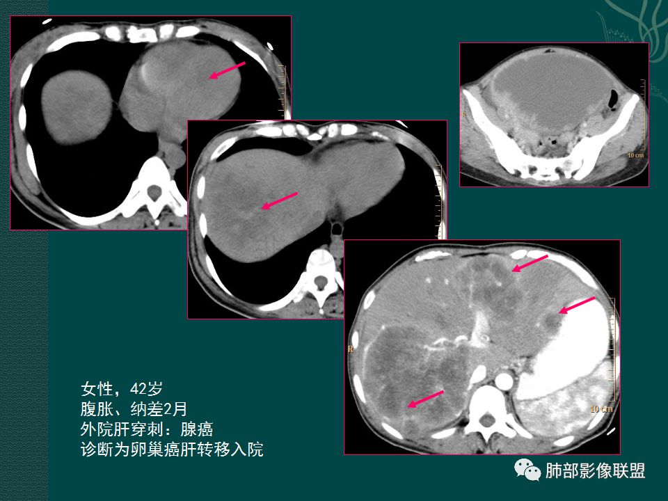 影像PPT - 【PPT】胃肠道肿瘤特征性影像浅析-46