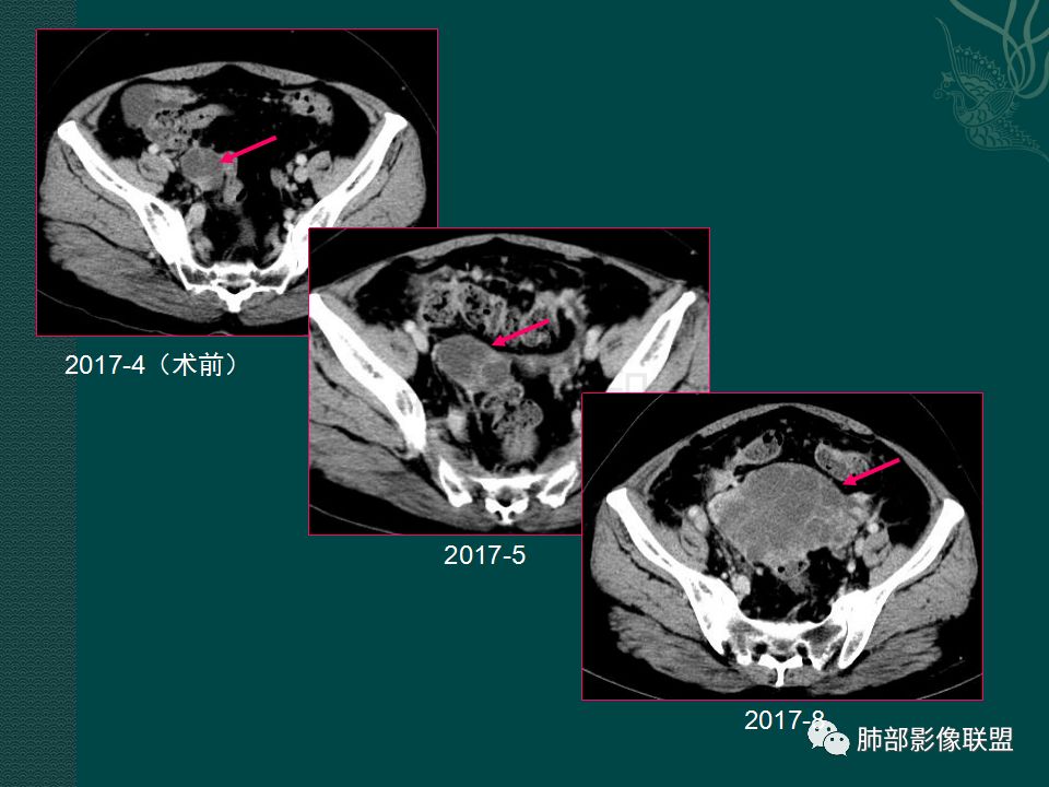 影像PPT - 【PPT】胃肠道肿瘤特征性影像浅析-52