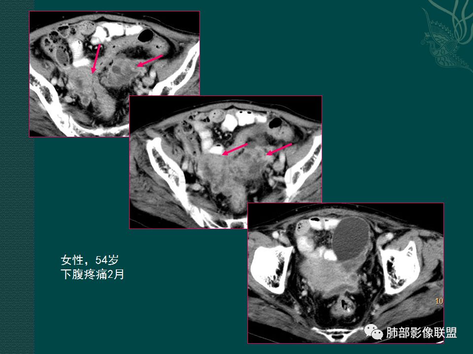 影像PPT - 【PPT】胃肠道肿瘤特征性影像浅析-57