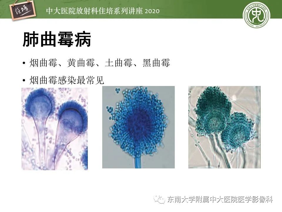 影像PPT - 【PPT】肺真菌病的影像诊断-10