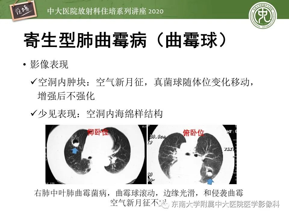 影像PPT - 【PPT】肺真菌病的影像诊断-16