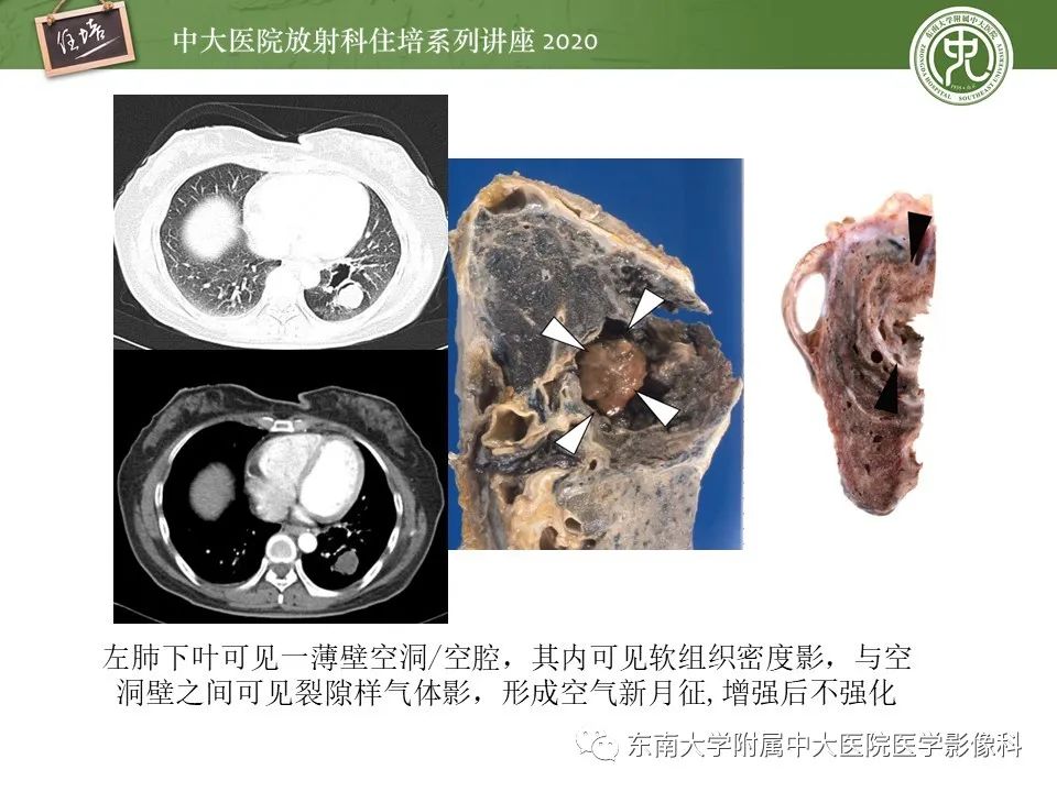 影像PPT - 【PPT】肺真菌病的影像诊断-17