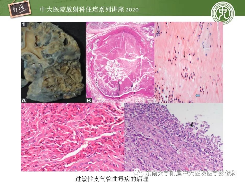 影像PPT - 【PPT】肺真菌病的影像诊断-19