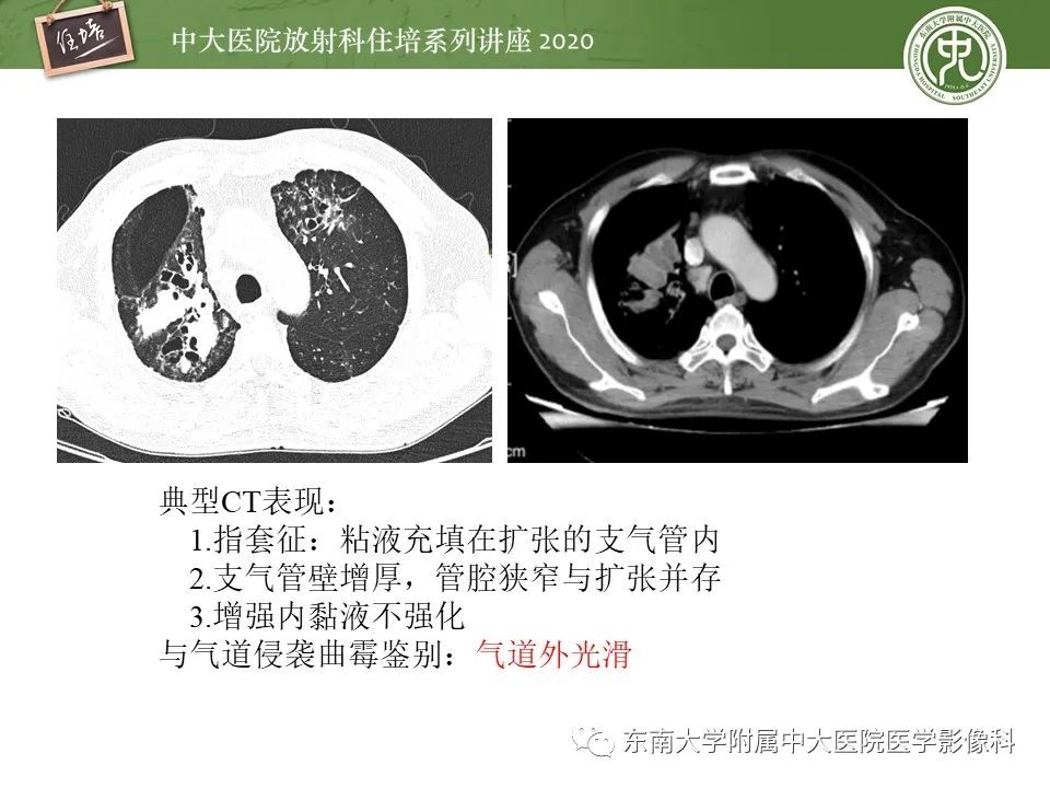 影像PPT - 【PPT】肺真菌病的影像诊断-21