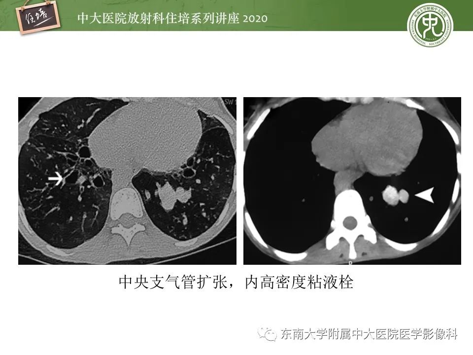 影像PPT - 【PPT】肺真菌病的影像诊断-22
