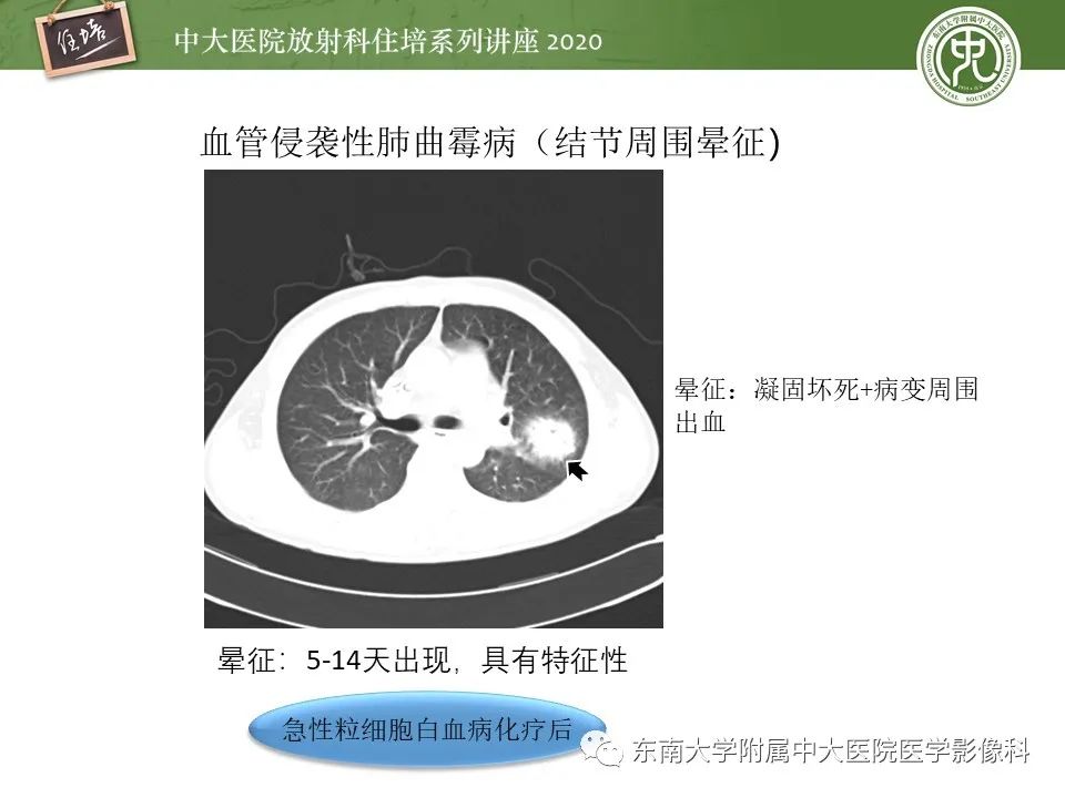 影像PPT - 【PPT】肺真菌病的影像诊断-25