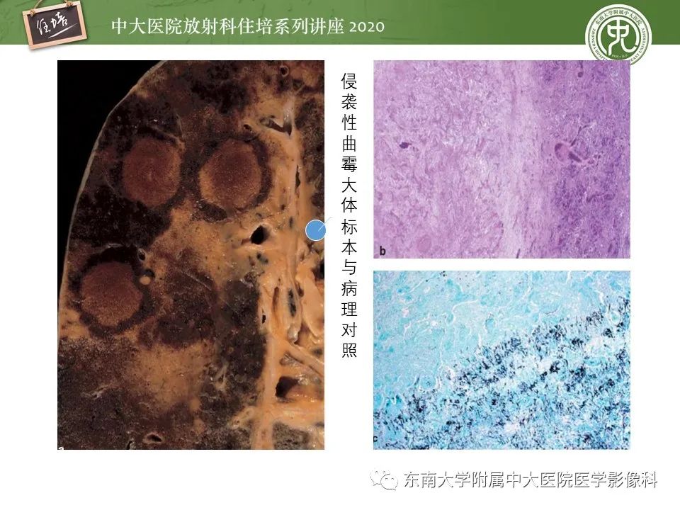 影像PPT - 【PPT】肺真菌病的影像诊断-26