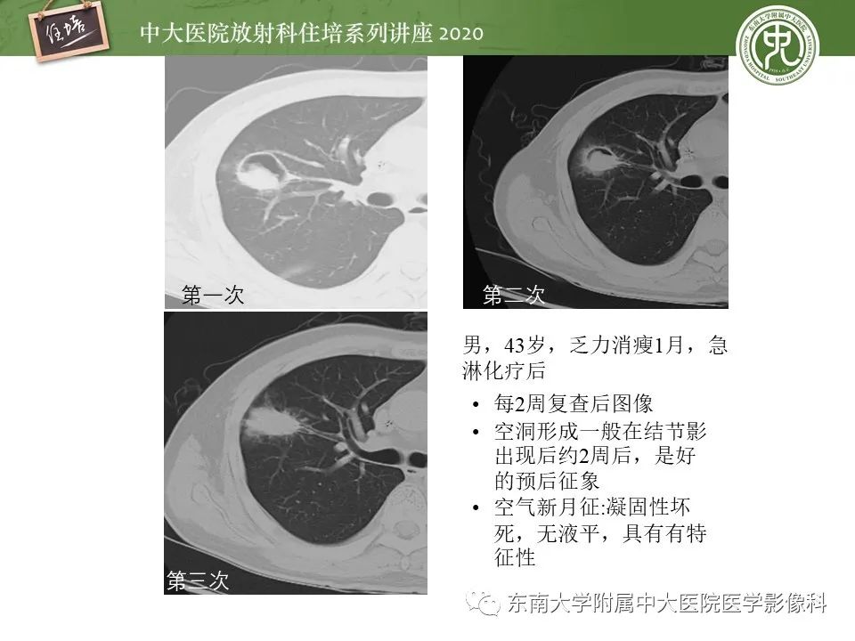 影像PPT - 【PPT】肺真菌病的影像诊断-27