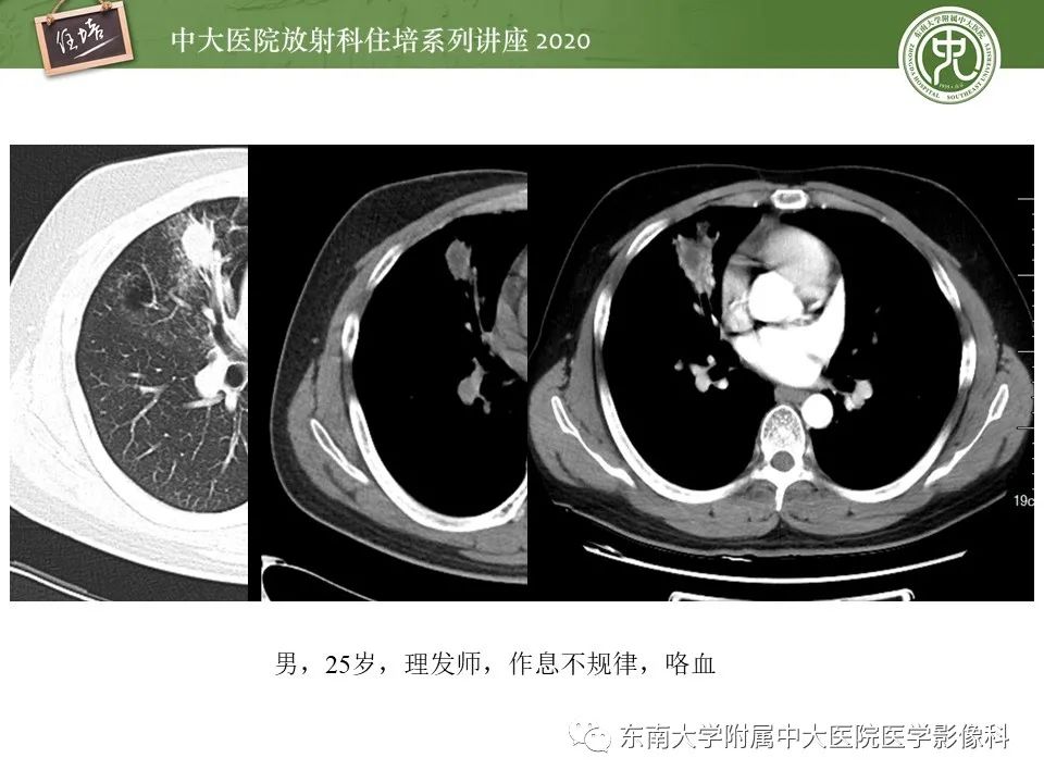 影像PPT - 【PPT】肺真菌病的影像诊断-28
