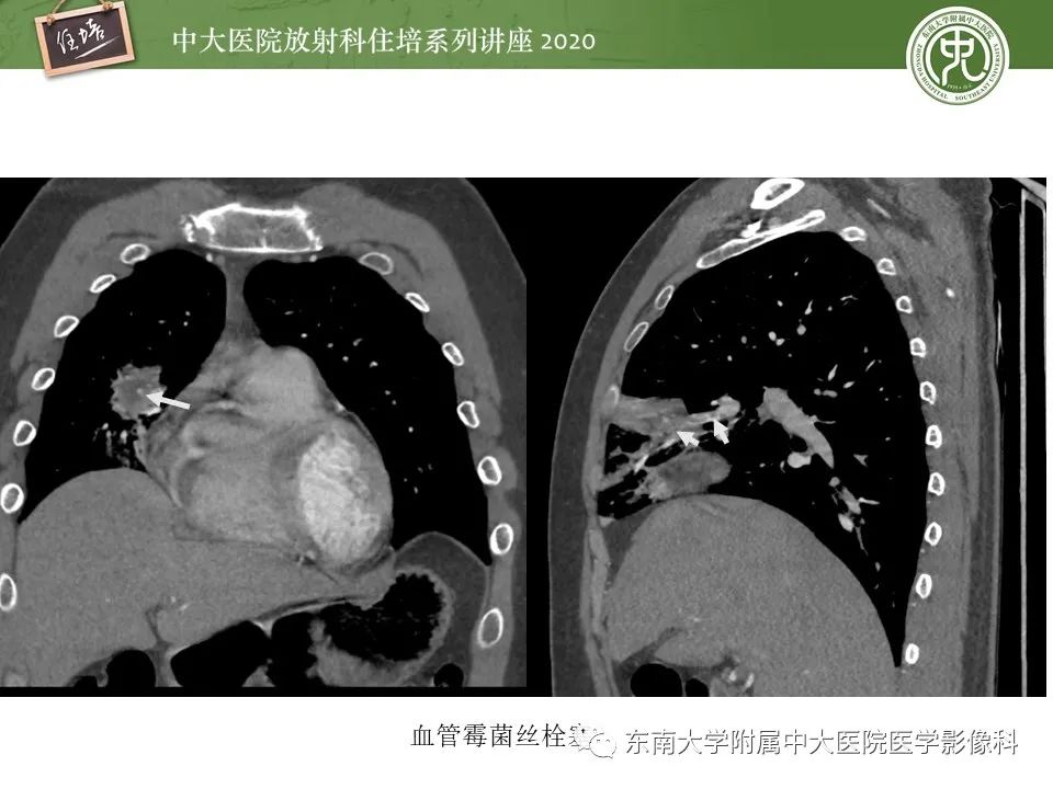 影像PPT - 【PPT】肺真菌病的影像诊断-29
