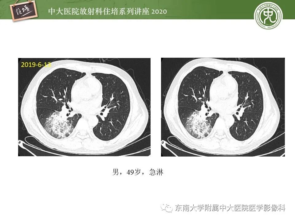 影像PPT - 【PPT】肺真菌病的影像诊断-30