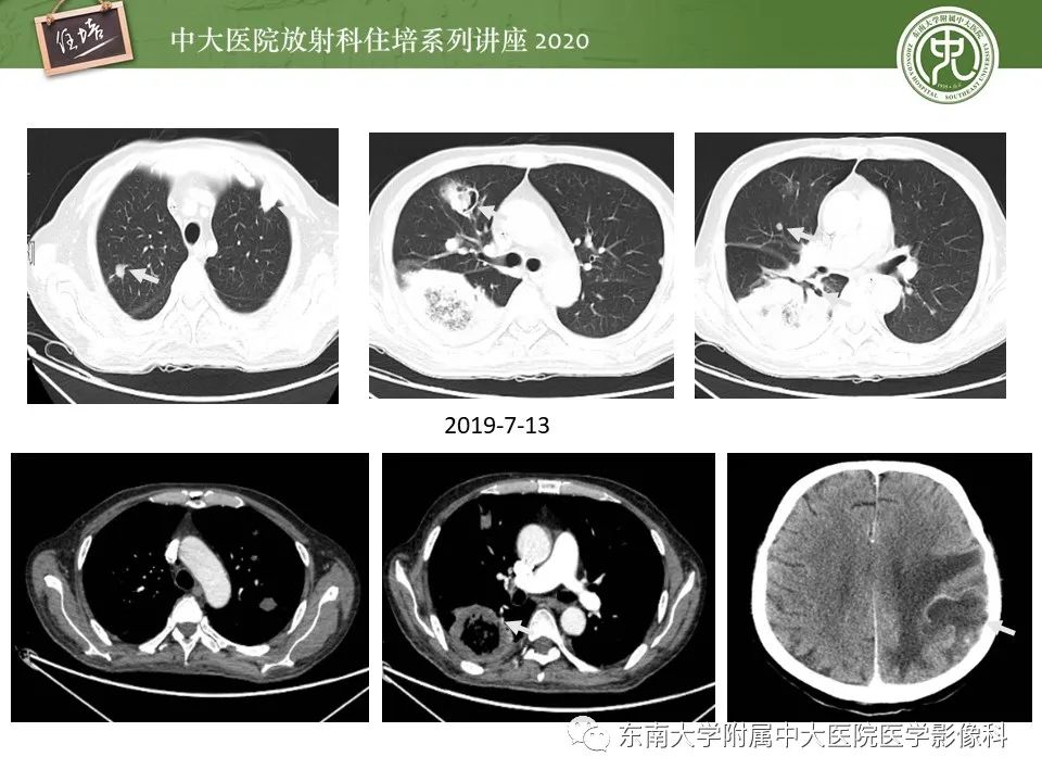 影像PPT - 【PPT】肺真菌病的影像诊断-31