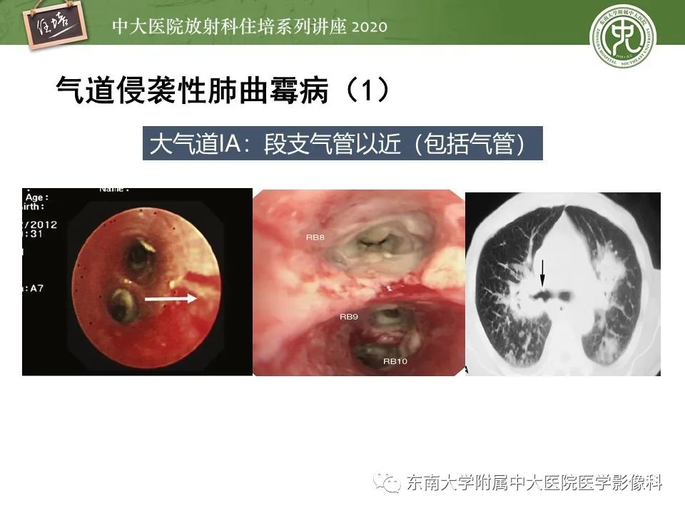 影像PPT - 【PPT】肺真菌病的影像诊断-32
