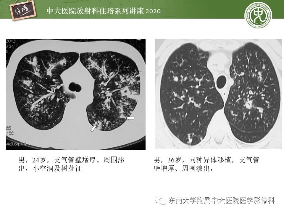 影像PPT - 【PPT】肺真菌病的影像诊断-34