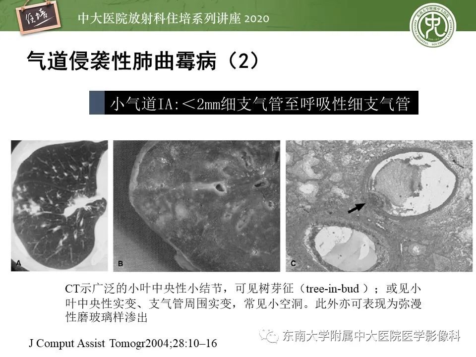 影像PPT - 【PPT】肺真菌病的影像诊断-35