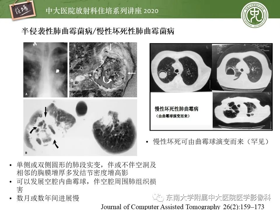 影像PPT - 【PPT】肺真菌病的影像诊断-37