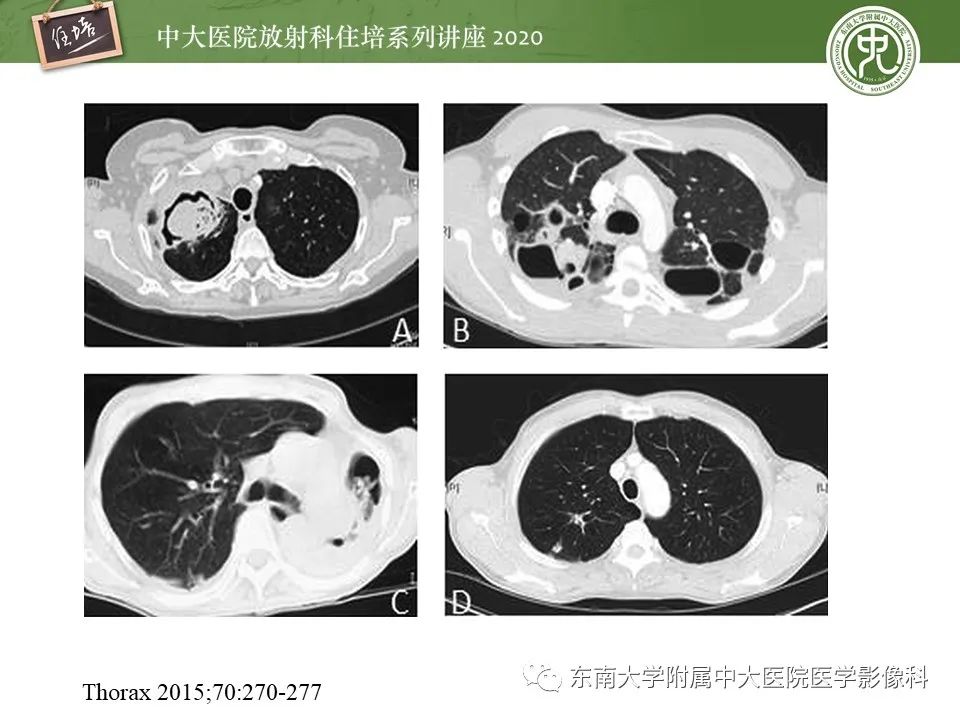 影像PPT - 【PPT】肺真菌病的影像诊断-38