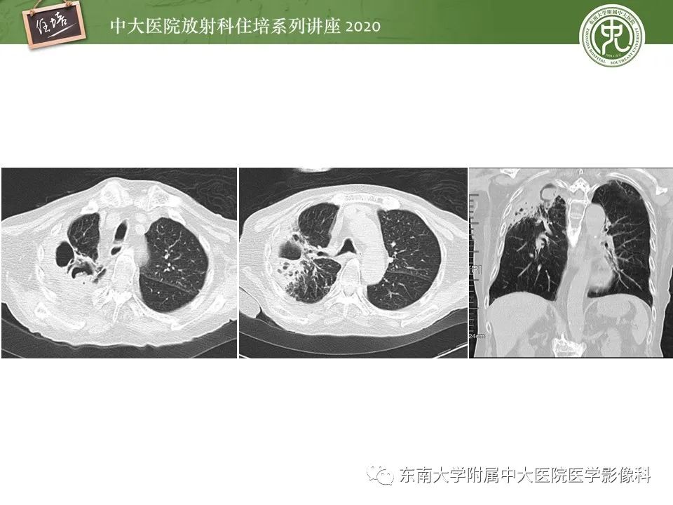影像PPT - 【PPT】肺真菌病的影像诊断-39