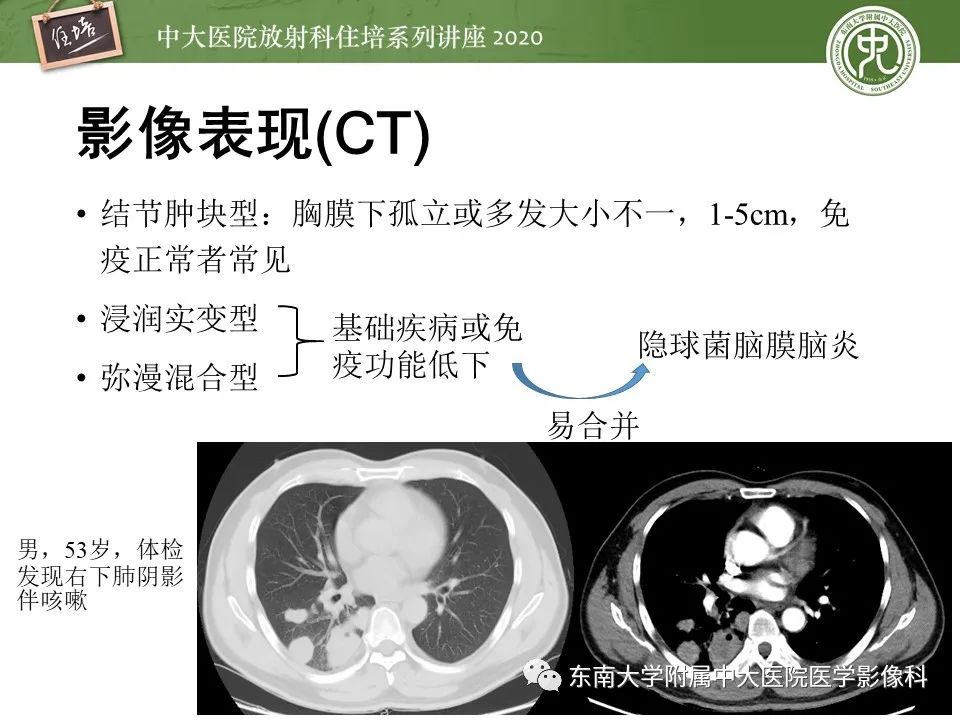 影像PPT - 【PPT】肺真菌病的影像诊断-41