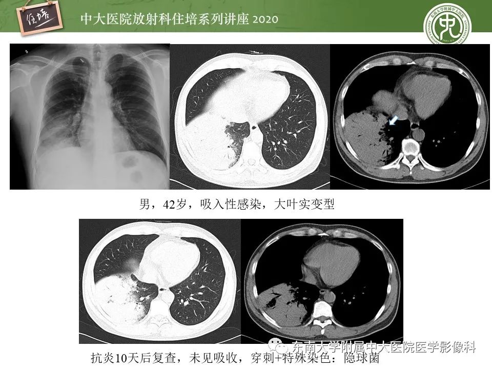 影像PPT - 【PPT】肺真菌病的影像诊断-42