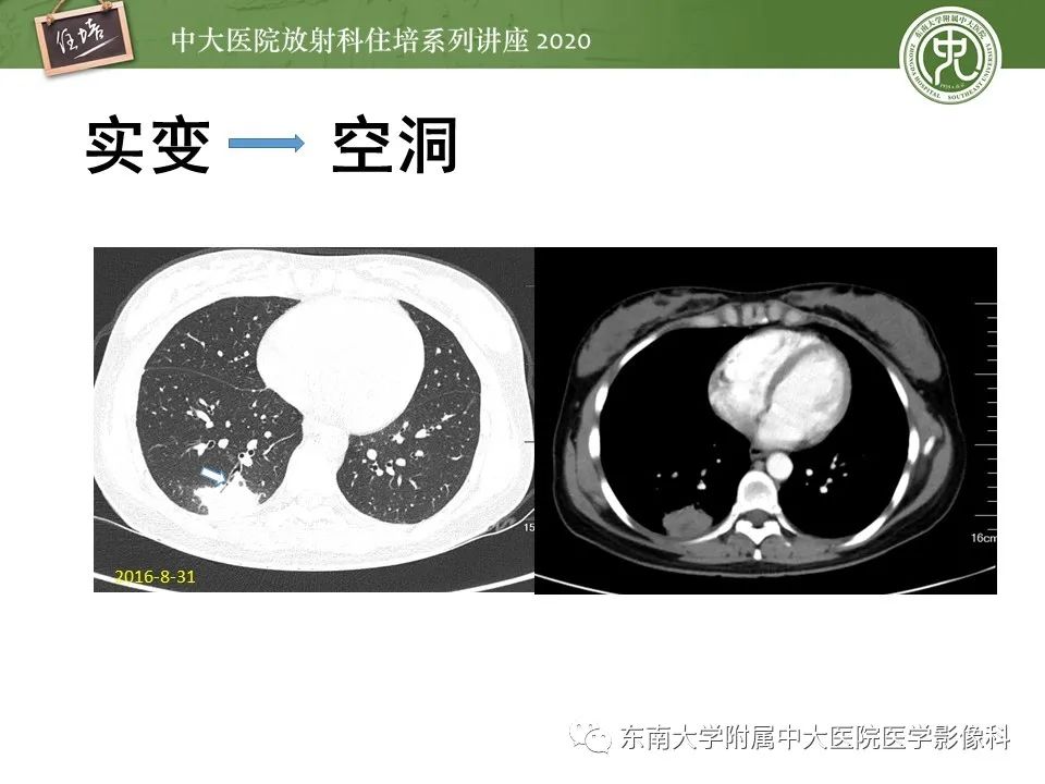 影像PPT - 【PPT】肺真菌病的影像诊断-43
