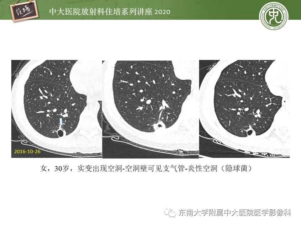 影像PPT - 【PPT】肺真菌病的影像诊断-44