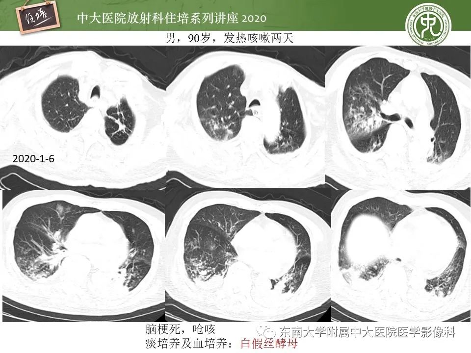 影像PPT - 【PPT】肺真菌病的影像诊断-46