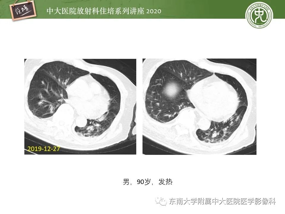 影像PPT - 【PPT】肺真菌病的影像诊断-47