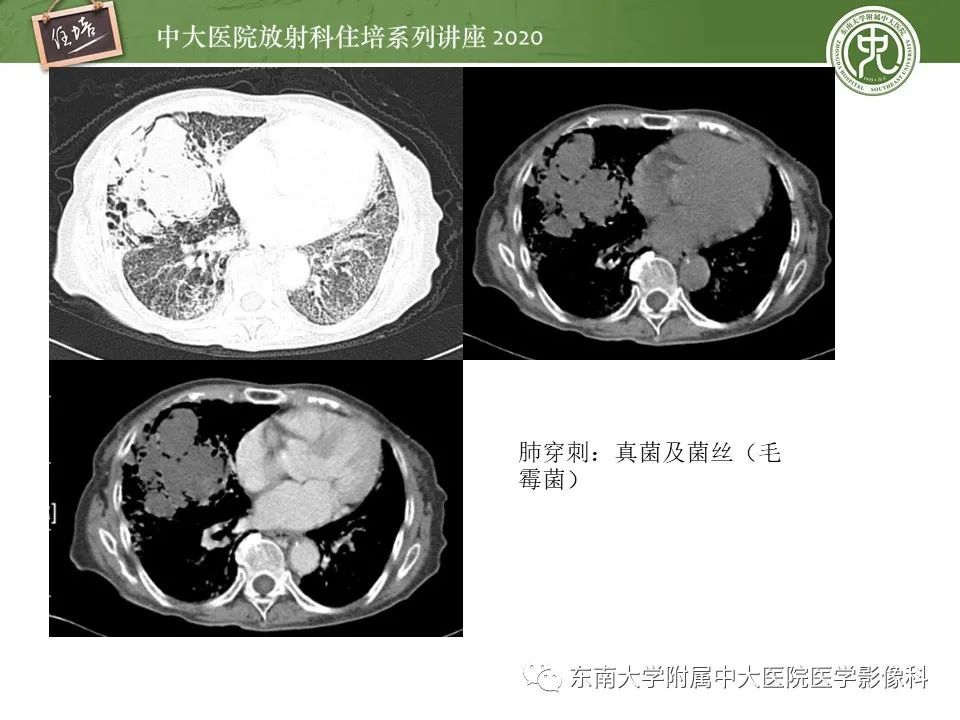 影像PPT - 【PPT】肺真菌病的影像诊断-50