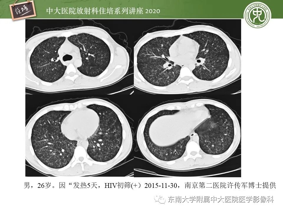 影像PPT - 【PPT】肺真菌病的影像诊断-5