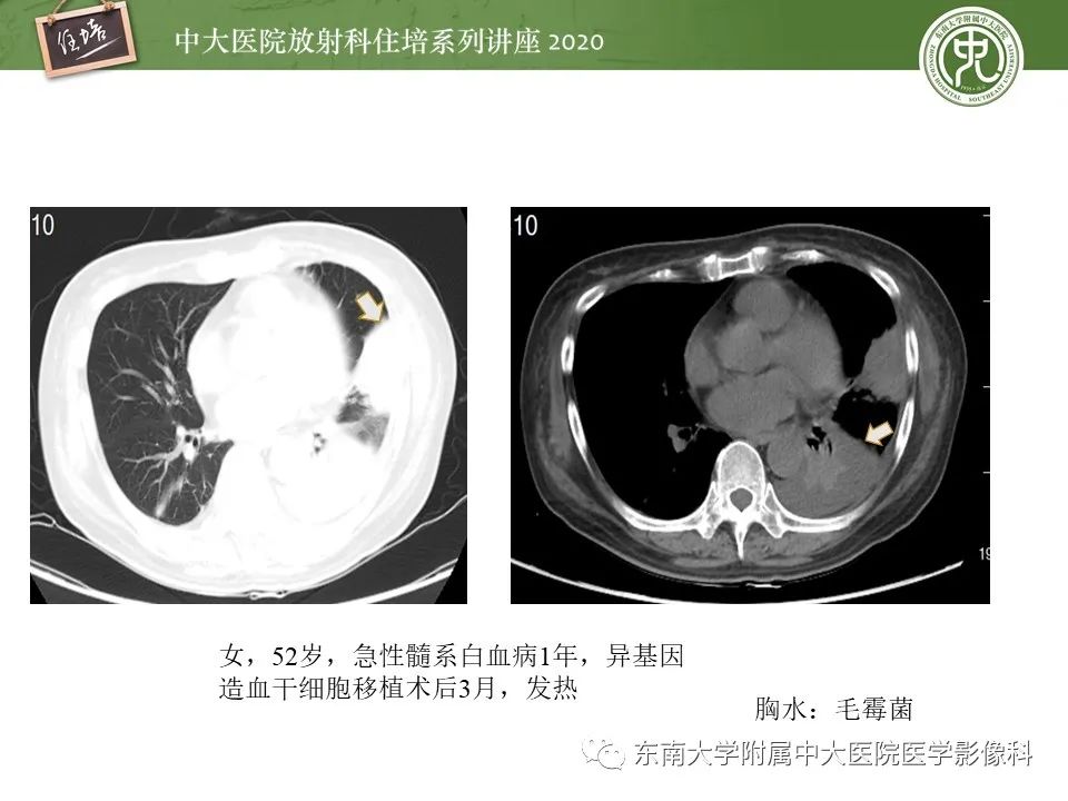 影像PPT - 【PPT】肺真菌病的影像诊断-1