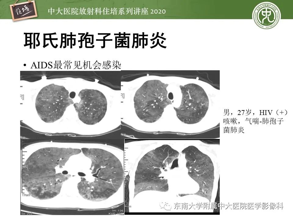 影像PPT - 【PPT】肺真菌病的影像诊断-2