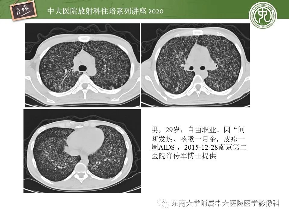 影像PPT - 【PPT】肺真菌病的影像诊断-6
