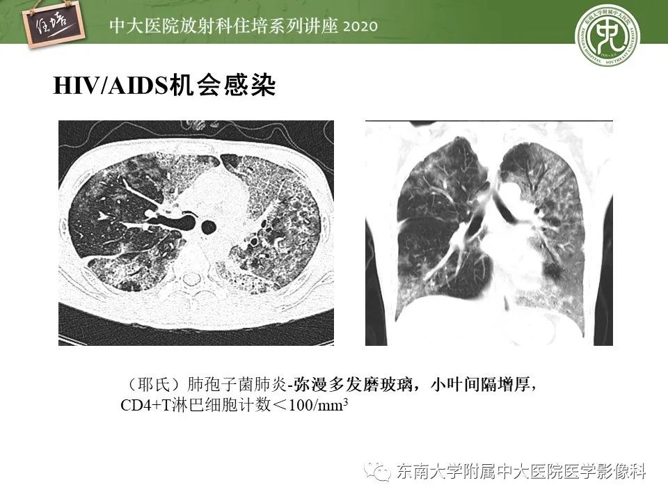 影像PPT - 【PPT】肺真菌病的影像诊断-3