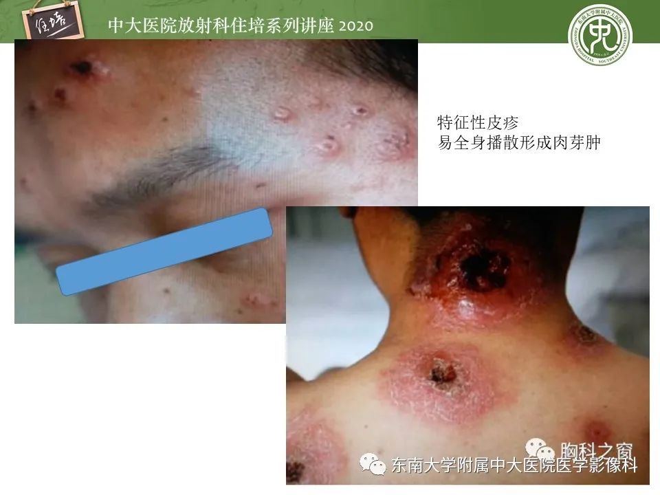 影像PPT - 【PPT】肺真菌病的影像诊断-7