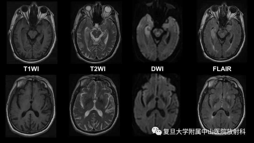 影像PPT - 【病例】边缘性脑炎—自身免疫性脑炎 VS 病毒性脑炎-5
