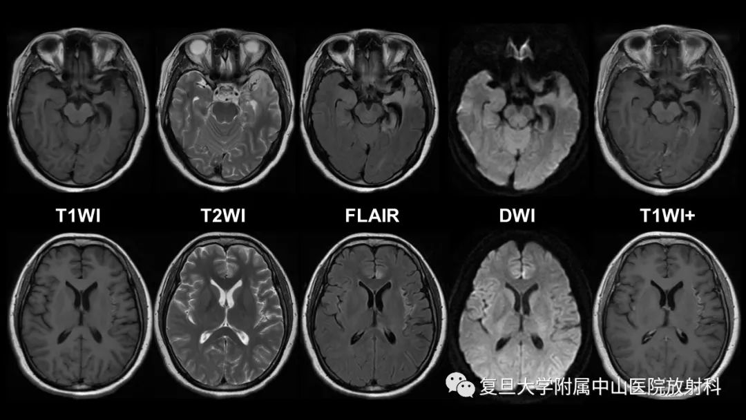 影像PPT - 【病例】边缘性脑炎—自身免疫性脑炎 VS 病毒性脑炎-7